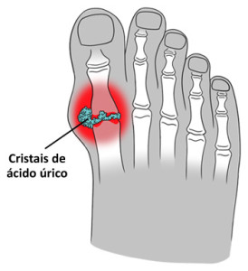 Imagem ilustrativa de uma gota no dedão do pé.