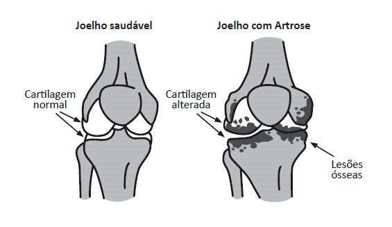 Ilustração de um joelho saudável e um joelho com cartilagem afetada
